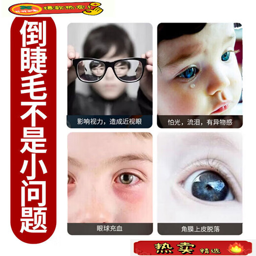 The official flagship of the ancient and modern inverted eyelash patch for children and infants, the magic tool for lower eyelid trichiasis ectropion and lifting, 3 boxes of treatment packages for severe inability to open eyelashes inverted, Fat Donglai online supermarket