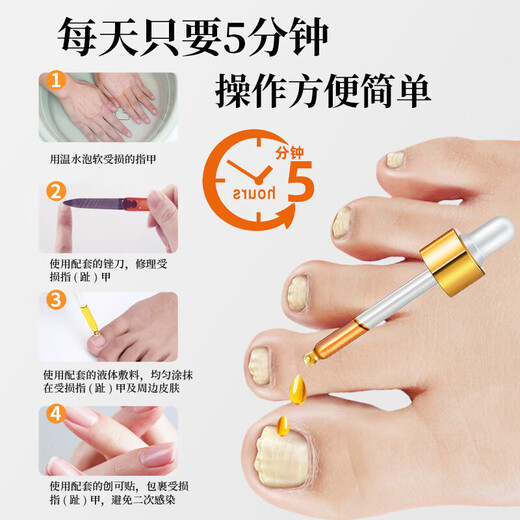 Tongrentang Onychomycosis Special Nail Fungus Infection Removal, Bad Nails, Bright Nails, Onychomycosis, Net Yellowing, Thickening and Empty 30ml
