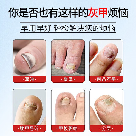 Tongrentang Onychomycosis Special Nail Fungus Infection Removal, Bad Nails, Bright Nails, Onychomycosis, Net Yellowing, Thickening and Empty 30ml