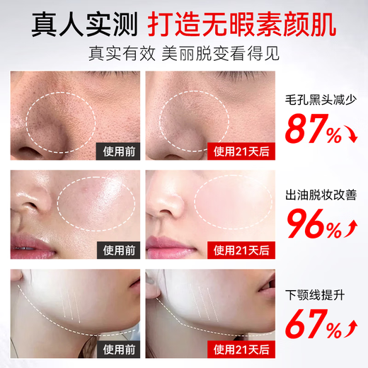 RASW German blackhead shovel ultrasonic blackhead remover electric blackhead suction tool pore cleaning import and export acne removal tool beauty instrument birthday gift anniversary gift for girls top model LED red and blue light skin care + delicate pores + ion export