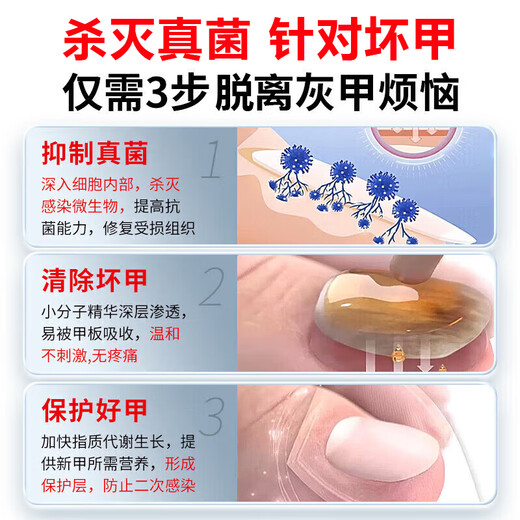 Tongrentang Onychomycosis Special Nail Fungus Infection Removal, Bad Nails, Bright Nails, Onychomycosis, Net Yellowing, Thickening and Empty 30ml