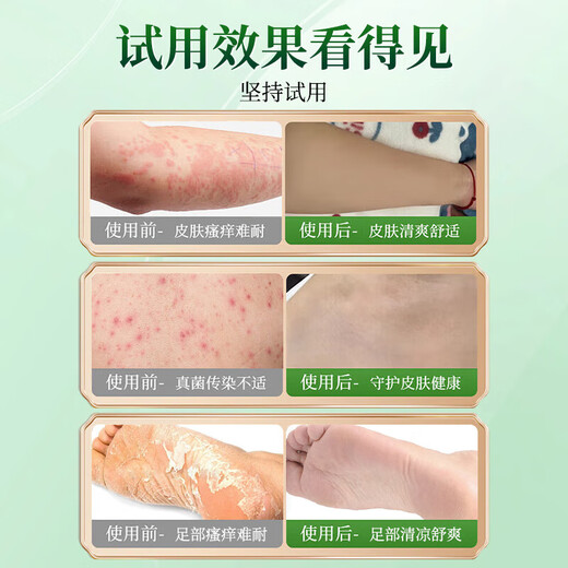 DAGO Hong Kong Fungus King, skin itching, fungal infection, athlete's foot, foot odor, anti-itching, peeling and rotten feet, special special effects genuine product
