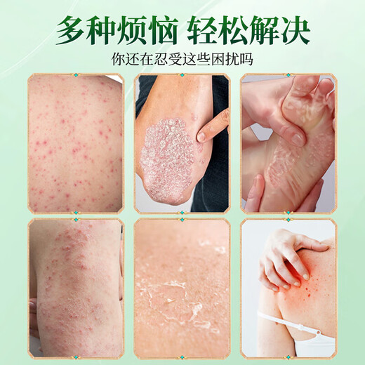 DAGO Hong Kong Fungus King, skin itching, fungal infection, athlete's foot, foot odor, anti-itching, peeling and rotten feet, special special effects genuine product