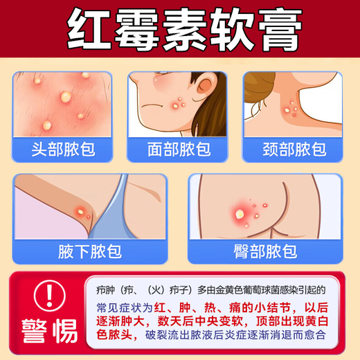 Erythromycin ointment, antibacterial, infection, anti-inflammatory and swelling fire boil special ointment, anti-inflammatory drug, anti-inflammatory and swelling fire boil removal ointment, fire boil, pustule, pimple, sebaceous gland cyst, boil, 3 boxes, long fire boil on the body, hard bag is particularly painful