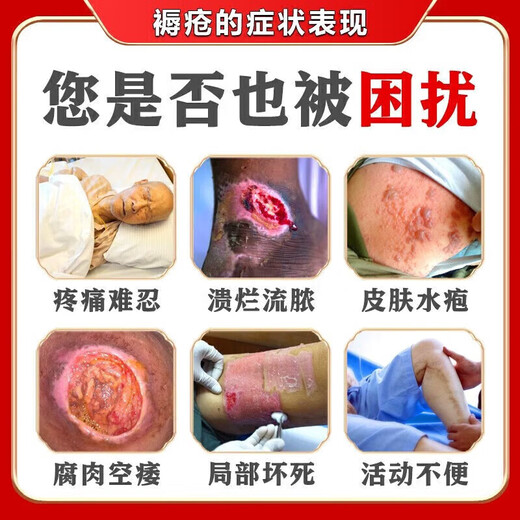 Decubitus Ointment Boric Acid Ointment treats pressure sores, pus, and ulcers, promotes healing, removes putrefaction, promotes muscle growth, trauma, and suppuration medicine. Blisters on old rotten legs and buttocks, long-term bed rest. 1 box. What to do about decubitus ulcers? Mild