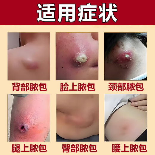 Erythromycin ointment, antibacterial, infection, anti-inflammatory and swelling fire boil special ointment, anti-inflammatory drug, anti-inflammatory and swelling fire boil removal ointment, fire boil, pustule, pimple, sebaceous gland cyst, boil, 3 boxes, long fire boil on the body, hard bag is particularly painful
