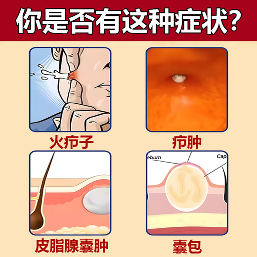 Erythromycin ointment, antibacterial, infection, anti-inflammatory and swelling fire boil special ointment, anti-inflammatory drug, anti-inflammatory and swelling fire boil removal ointment, fire boil, pustule, pimple, sebaceous gland cyst, boil, 3 boxes, long fire boil on the body, hard bag is particularly painful