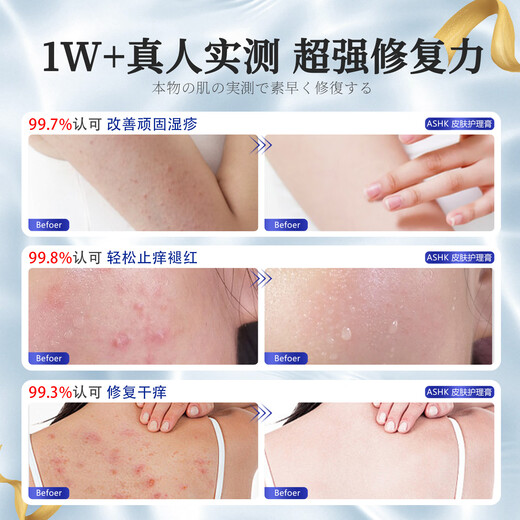 ASHK eczema plaster skin itching erythema antipruritic cream fungal infection sweat herpes anal itching 20g*1 box