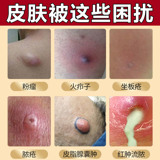 Erythromycin ointment, antibacterial, infection, anti-inflammatory and swelling fire boil special ointment, anti-inflammatory drug, anti-inflammatory and swelling fire boil removal ointment, fire boil, pustule, pimple, sebaceous gland cyst, boil, 3 boxes, long fire boil on the body, hard bag is particularly painful