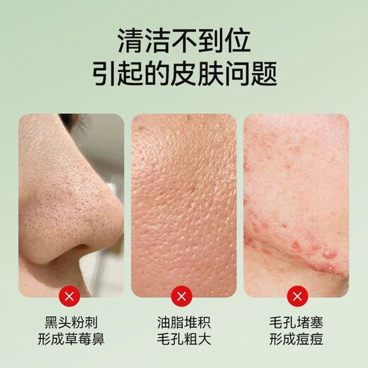 KONKA visual blackhead suction instrument cleaner electric blackhead instrument facial pore cleaning acne home beauty instrument tail cargo machine upgraded model direct pore attack two-speed operation