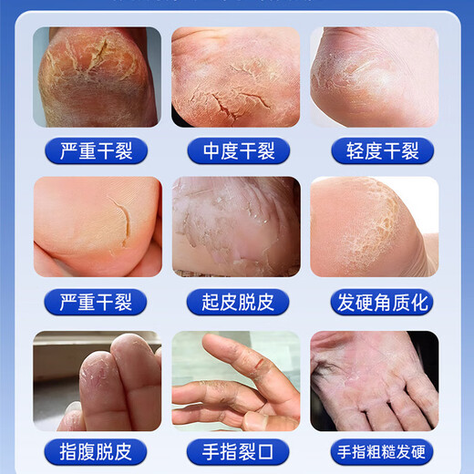 Japan's Dingding Foot Cracked Cream Gel-Free Heel Cracked Heel Cracked Heel Cracked Hand Repair Cream Hand and Foot Care 1 Bottle