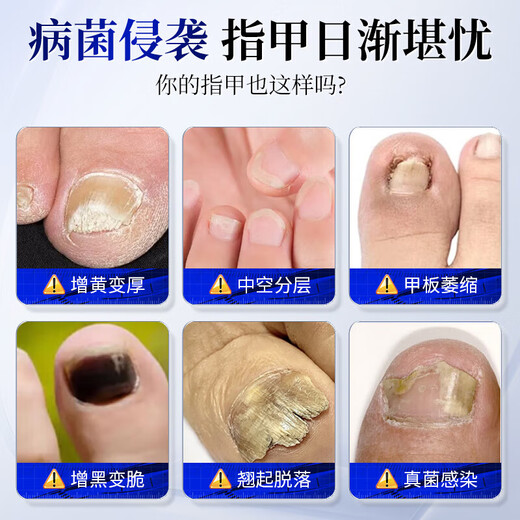 Layanana special effect on onychomycosis, special use of yellowing and thickening root cream to treat nail infection, removal of onychomycosis and bactericidal liquid cream 30ml