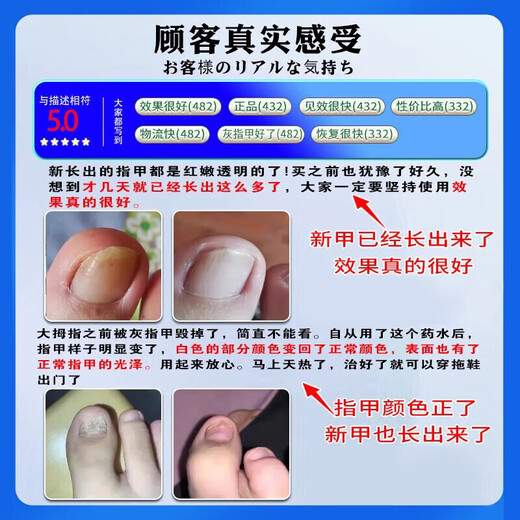 Japanese onychomycosis special effect medicine for brightening onychomycosis i cures authentic fungal infection, brightens onychomycosis, imported antibacterial, buy 2 get 1 free, 80% of customers choose the upgraded version, special for brightening thick onychomycosis, Jingdong Pharmacy