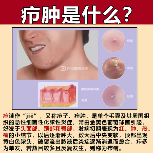 Erythromycin ointment, antibacterial, infection, anti-inflammatory and swelling fire boil special ointment, anti-inflammatory drug, anti-inflammatory and swelling fire boil removal ointment, fire boil, pustule, pimple, sebaceous gland cyst, boil, 3 boxes, long fire boil on the body, hard bag is particularly painful