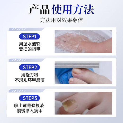Layanana special effect on onychomycosis, special use of yellowing and thickening root cream to treat nail infection, removal of onychomycosis and bactericidal liquid cream 30ml