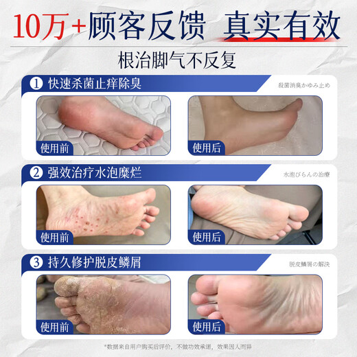 Jiub Pharmaceutical Athlete's Foot Spray to relieve itching, peeling, rotten feet, fungal infection, smelly feet, itchy feet, deodorant, anti-itching, sterilization and antibacterial 3 boxes