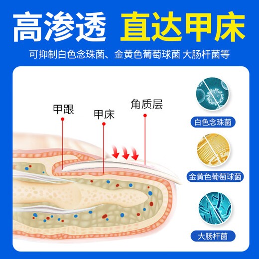 To correct onychomycosis, Chinese medicine can be used to cure nail fungal infection. New nail antibacterial solution 60ml for removing and destroying the nail.