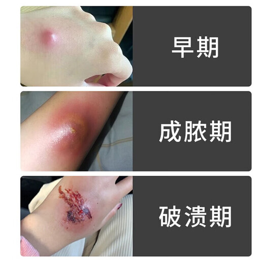 Fire boil ointment for pimples on the back of the neck, white hard lumps, pustules, redness and pus, gas pimples, acne, hard fat lumps, cysts, sores, small area burns, skin disease medicine, erythromycin ointment 1 box