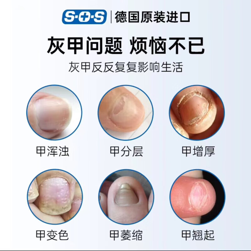 SOS German original imported SOS special medicine for onychomycosis, antibacterial liquid, manicure liquid 3ml single