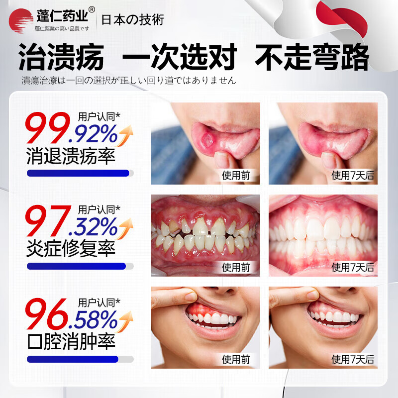 Pengren Pharmaceutical Oral Ulcer Repair Gel is a special medicine for oral ulcers. Children with sores and inflammation of the mouth and tongue can wear Oral Ulcer Patch. Oral Ulcer Powder can be used. Watermelon Cream Oral Ulcer Spray Yidianling