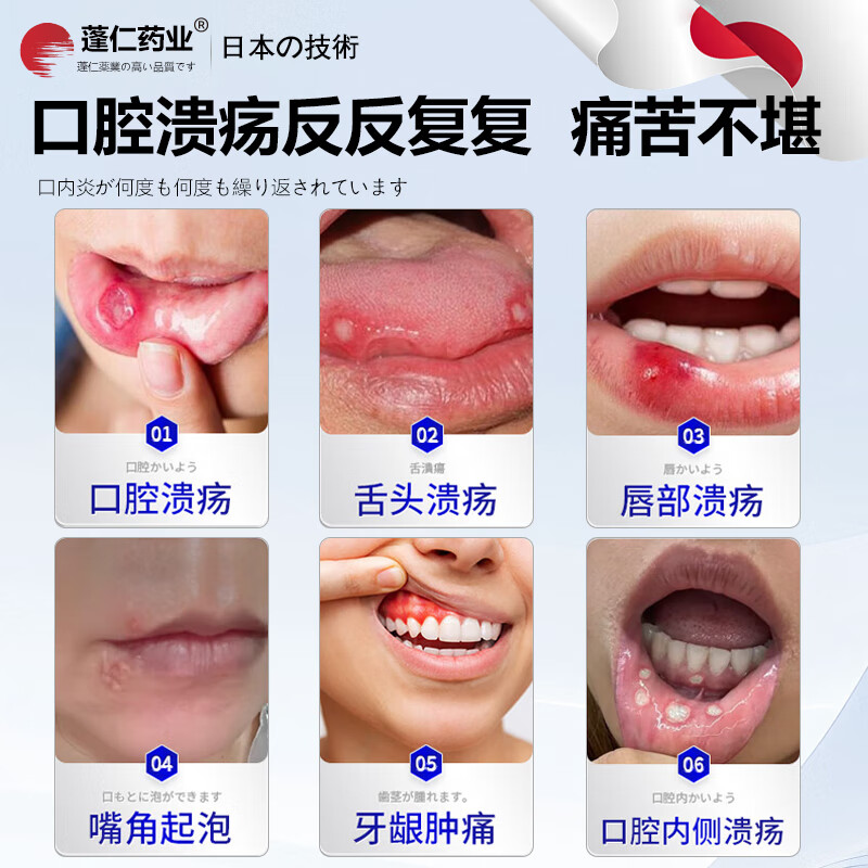 Pengren Pharmaceutical Oral Ulcer Repair Gel is a special medicine for oral ulcers. Children with sores and inflammation of the mouth and tongue can wear Oral Ulcer Patch. Oral Ulcer Powder can be used. Watermelon Cream Oral Ulcer Spray Yidianling