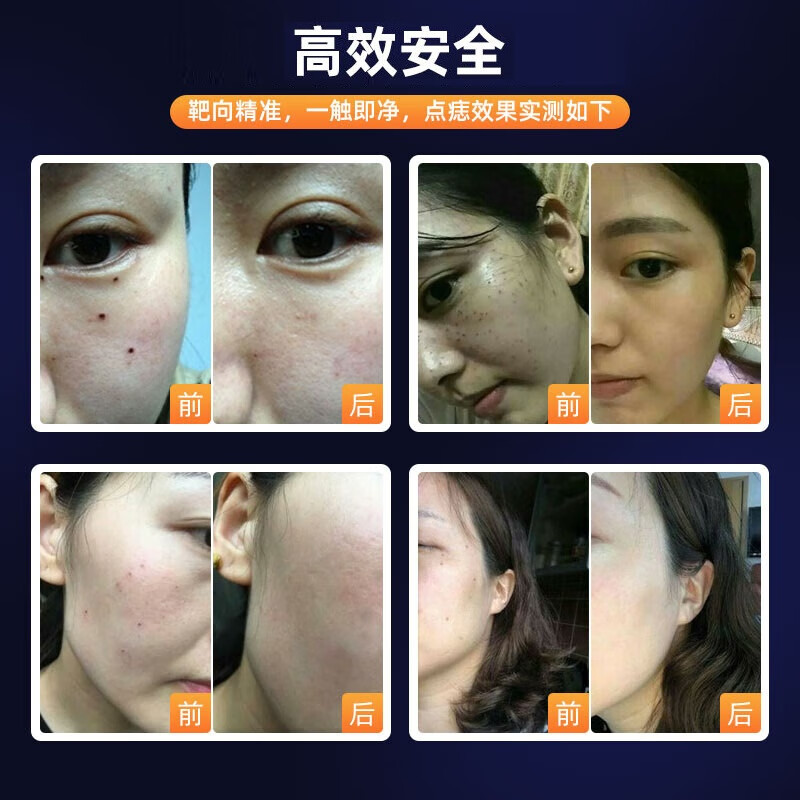 NHGAD mole spot laser pen to remove moles, moles, flat moles, spot wart removal instrument, beauty salon special spot scanning small whitening mole removal pen