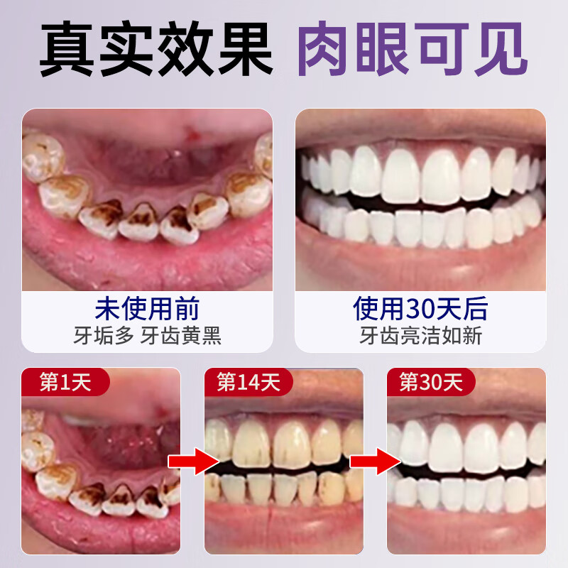 SOVIP Germany's dental calculus cleaning artifact removes bad breath, removes yellow tooth stains, removes tobacco stains, and is the first in the gold list for non-toothpaste adults