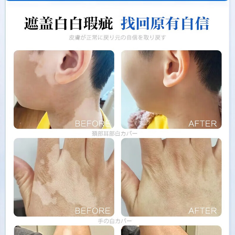 Taozhiyaoyao Vitiligo Concealer Liquid Covers White Spots Long-lasting Hand and Face Pen Cream Skin Color Concealer Artifact Waterproof and Not Easy to Fade