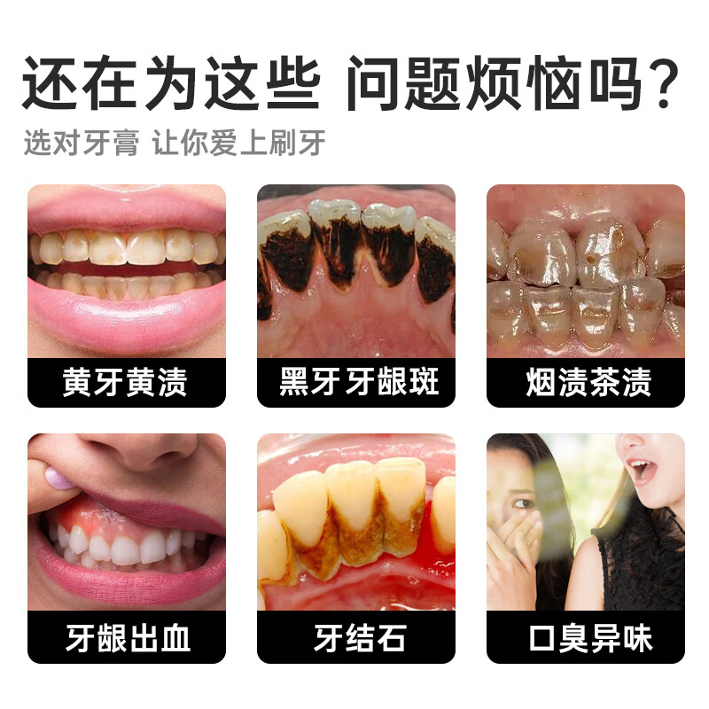 LD zeolite whitening toothpaste removes yellowing, removes tooth stains, tobacco stains, tartar and stones, inhibits bacteria and removes bad breath, top ten well-known brands*2