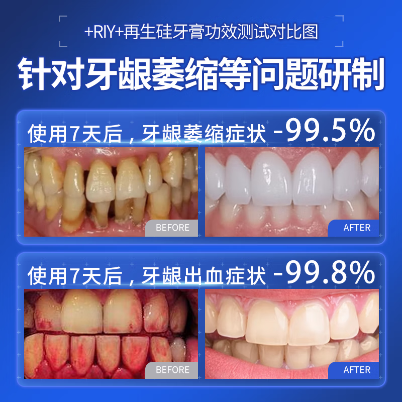 BEAI special heavy-duty repair regeneration silicon toothpaste for gum recession to protect gums and remove bad breath, yellow teeth, calculus and tooth stains 100g