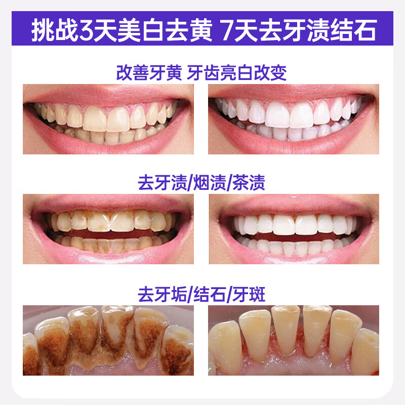 LD zeolite whitening toothpaste removes yellowing, removes tooth stains, tobacco stains, tartar and stones, inhibits bacteria and removes bad breath, top ten well-known brands*2