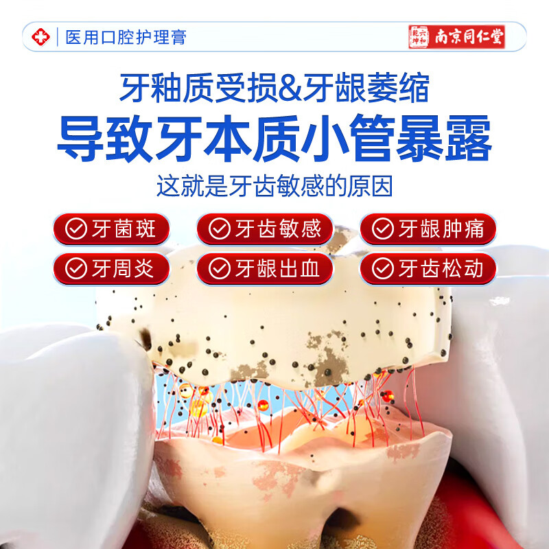 Nanjing Tongrentang dental desensitization cream for bleeding gums, receding gums, sensitivity, soreness, pain, loosening, oral care desensitization cream 2 boxes, bleeding gums, redness, swelling and soreness