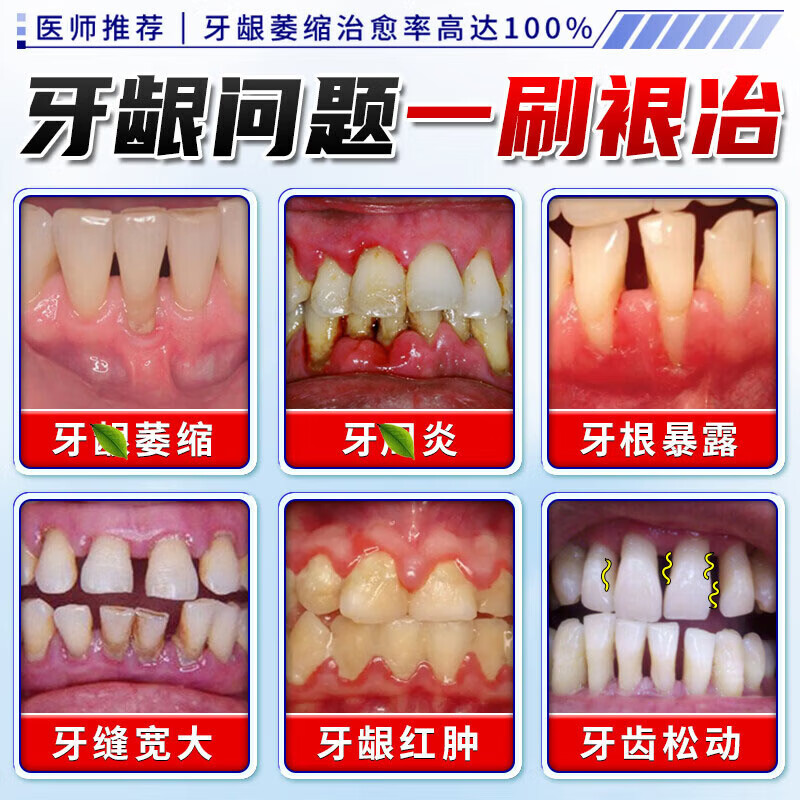 Sensodyne Repair Gum I Recession Anti-allergic Toothpaste Gum Protector Fix Teeth Reduction Gum I Recession Repair Regenerate Root Exposed Desensitization Special Effect 5 Boxes Cured No Longer Error Buy 3 Get 2 Free