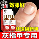 To correct onychomycosis, Chinese medicine can be used to cure nail fungal infection. New nail antibacterial solution 60ml for removing and destroying the nail.