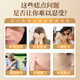 Dr. Mo's Hong Kong Pharmacy Mole Spot and Mole Removal Cream, No Scars on the Face, Black Mole Painless Repair Solution, Available for Children