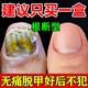 Special effects on onychomycosis. Nail thickening, yellowing, thickening and emptying. Fungal infection. Original imported from Japan. Onychomycosis ointment. 1 box. What is the best medicine for onychomycosis in Jingdong store? Quick onychomycosis special ointment room