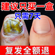 The No. 1 onychomycosis effect in Hong Kong Pharmacy, special nail fungus infection, yellowing and thickening of onychomycosis, impatiens antibacterial liquid, 2-5 onychomycosis, highly recommended, 69% people choose 3 boxes