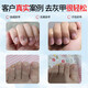 Tongrentang Onychomycosis Special Nail Fungus Infection Removal, Bad Nails, Bright Nails, Onychomycosis, Net Yellowing, Thickening and Empty 30ml