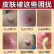 Erythromycin ointment, antibacterial, infection, anti-inflammatory and swelling fire boil special ointment, anti-inflammatory drug, anti-inflammatory and swelling fire boil removal ointment, fire boil, pustule, pimple, sebaceous gland cyst, boil, 3 boxes, long fire boil on the body, hard bag is particularly painful