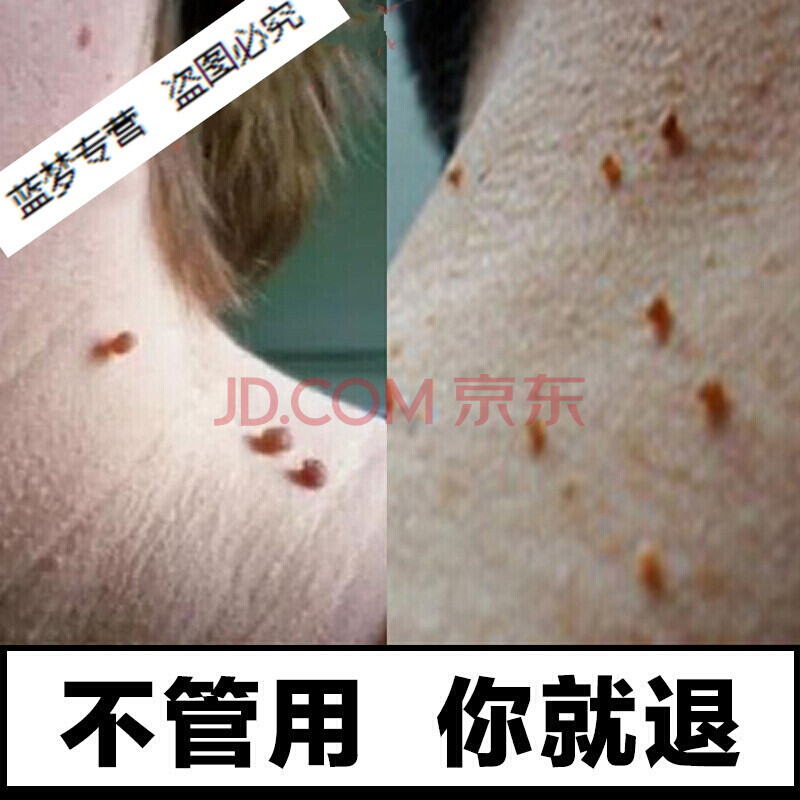 去除脖子小肉粒絲狀優疣去除膏脖子小肉粒疙瘩頸部扁平尤治皮贅肉ci刺