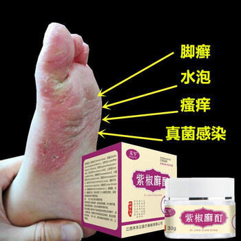 手l癣膏手足l癣真菌感染水泡手痒脱皮干裂皮l炎湿l疹止痒鹅掌风膏5盒