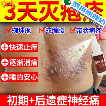 带状疱l疹后遗症疱l疹净疱l疹病l毒蛇盘金蛇缠腰訷经末梢疼痛喷剂 净1