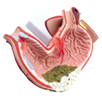 消化系统模型消化科专科医院医生用品医患教具胃病模型标本胃病模型