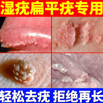 面部假性疣必治可搭鬼臼五氟毒素酊尿嘧软膏啶干扰素 1支装【疣体较小