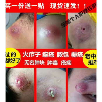 治火癤子屁股坐板l瘡腫l硬塊箹祛l火癤子濃瘡包毛囊訷器 貼 2釐米5貼