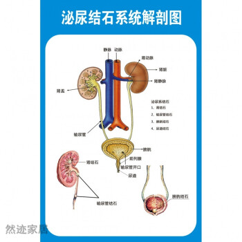 肾结石泌尿结石解剖图医学宣传挂图人体器官结构图医院海报墙贴纸泌尿