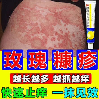 红斑湿疹鳞屑全身痒皮肤瘙痒玫瑰糠疹止痒特效用药膏糠酸莫米松乳膏 3