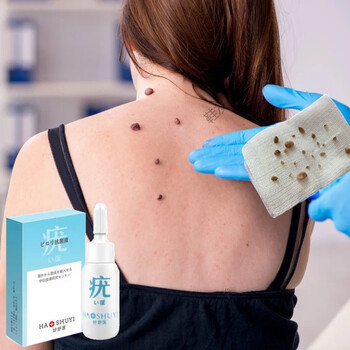 【日本原料】去除脖子小肉粒颈部赘皮扁皮尤祛1疣瘊丝状尤腋下猴子