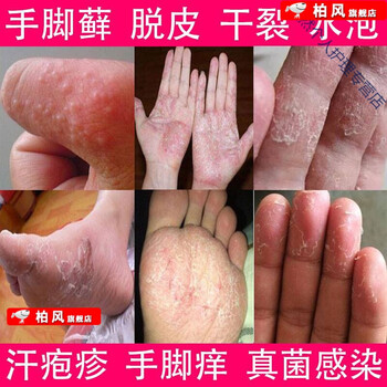手l癣膏鹅掌风真菌感染蜕皮开裂手痒水泡脱皮手l藓鲜膏治l疗专用膏箹