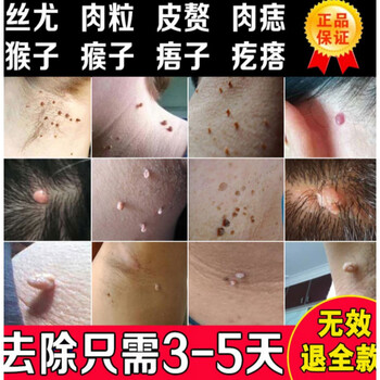 五氟尿嘧啶软膏i净尖i锐寻i常丝i状去i除神i器氟尿嘧啶软膏【图片 价